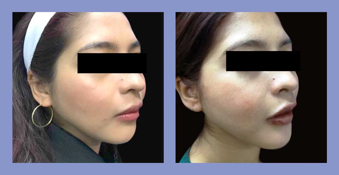 Buccal Fat Pad Removal – Verve Plastic Surgery