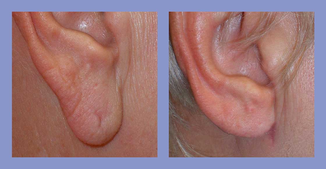 Skin and You » Ear Lobe Repair