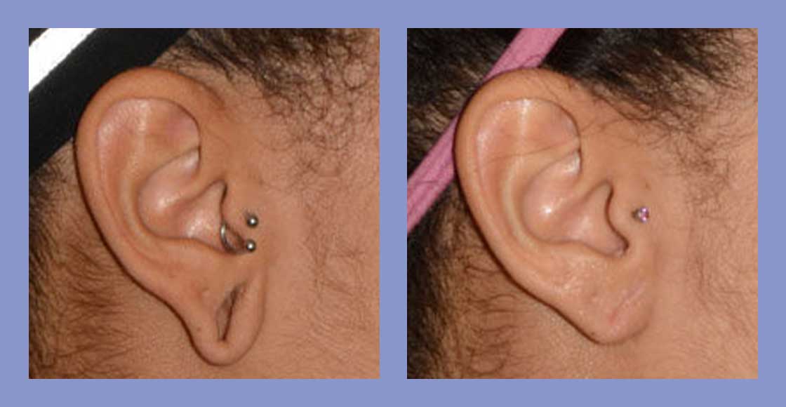 5 Questions People Ask Before an Earlobe Reconstruction Surgery - Plastic  Surgeon Beverly Hills, California