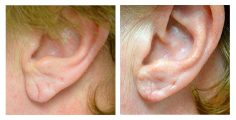 Ear lobe repair with Plastic Surgery - AMICUS CLINIC